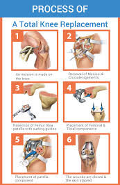 total knee replacement surgical procedure